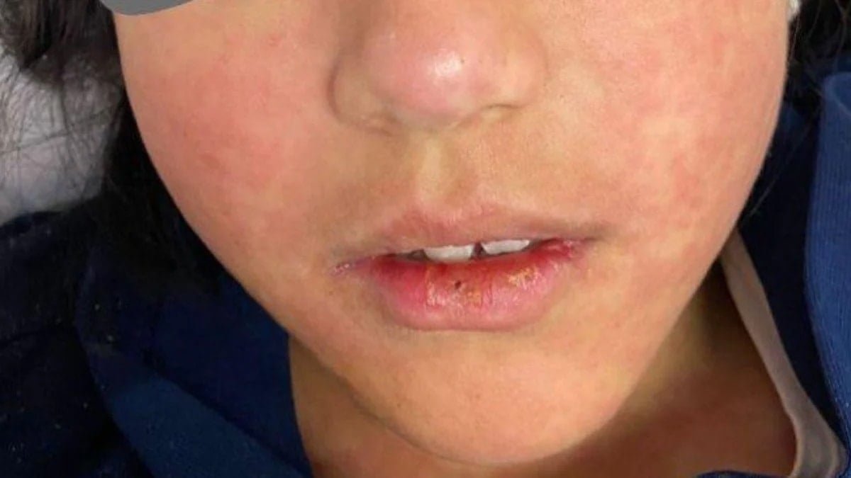 Hastalık yayılıyor, 6 haftada 227 çocuk öldü